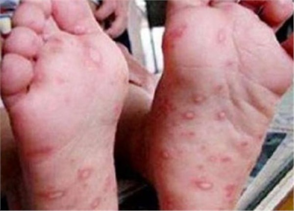 大多数患儿症状细微,以发热和手,足,口腔等部位的皮疹或疱疹为主要
