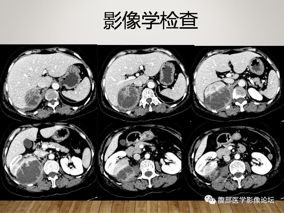 (右肾)黄色肉芽肿性肾盂肾炎