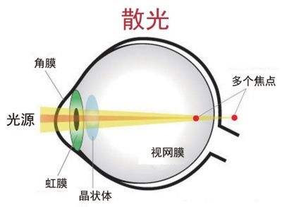 散光原因图片