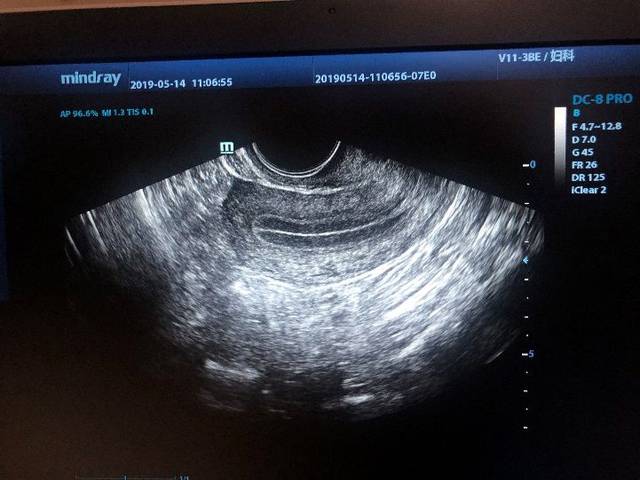 宫腔线变形图片