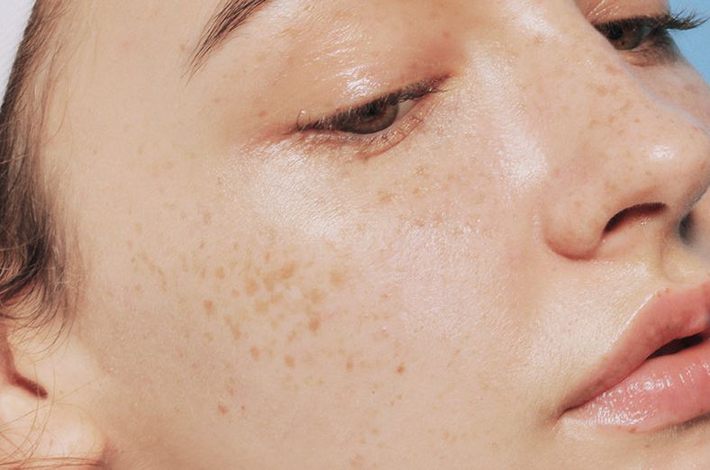 对很多追求完美的姑娘来说,脸上的斑点,仿佛是揉进眼里的一粒沙,扎进