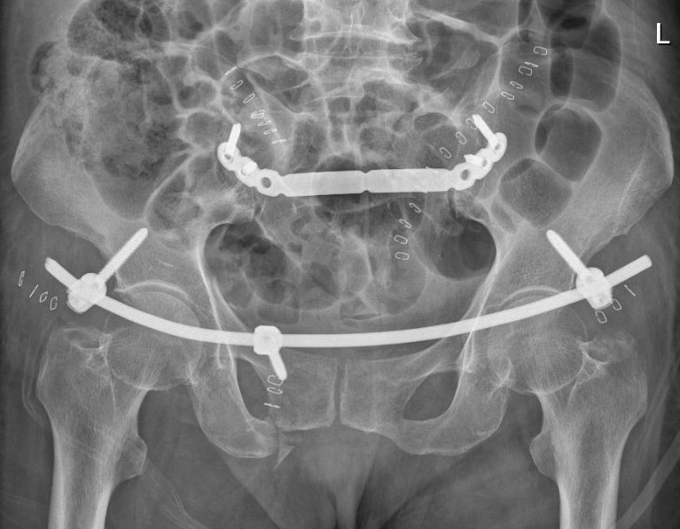 创伤骨科二病区应用infix 门型钢板微创治疗骨盆c型骨折手术成功实施