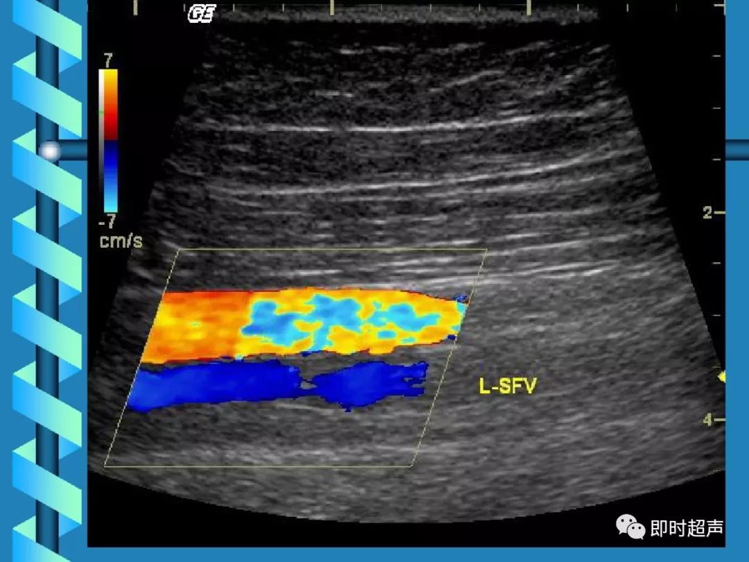 下肢深静脉血栓的超声诊断