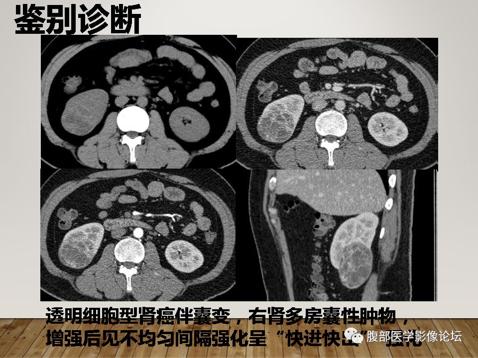 (右肾)黄色肉芽肿性肾盂肾炎