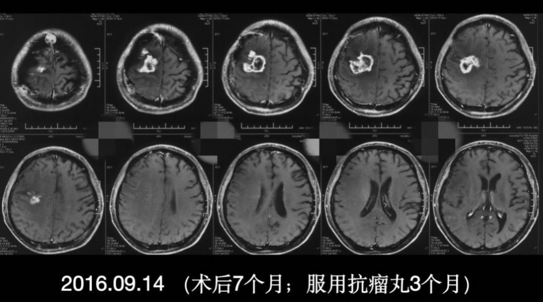 中药制剂抗瘤丸治疗复发神经胶质瘤患者招募启动会召开