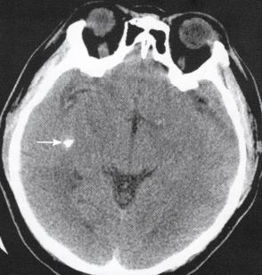 中级病例颅内海绵状血管瘤影像表现