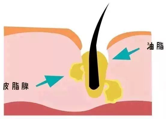 油脂分泌过盛,毛孔就会变得粗大以及女性生理周期,怀孕,精神压力等