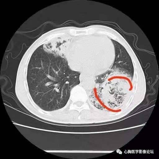 市中心醫院 感染科:結核 奴卡 真菌天津梅賽兒醫學影像中心 蔡:不支持