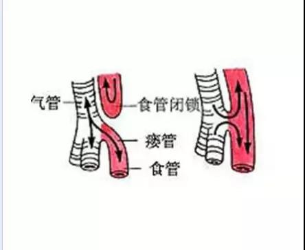 由于食道气管瘘的病因很复杂,所以每位的病情都不同,又没有特效的治疗