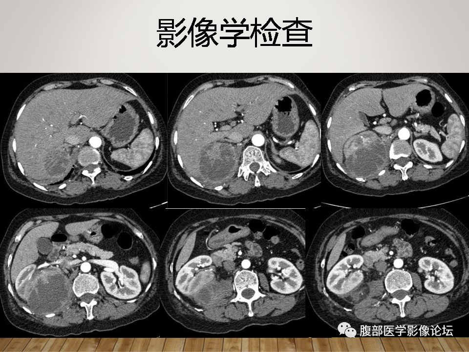 (右肾)黄色肉芽肿性肾盂肾炎