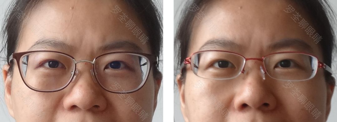 戴近视眼镜后真的会变丑眼科医生坐不住了