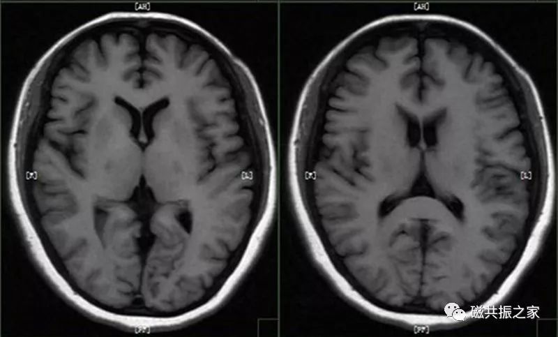 颅脑mri检查序列及临床应用