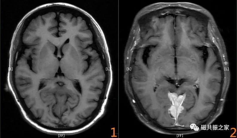 颅脑mri检查序列及临床应用