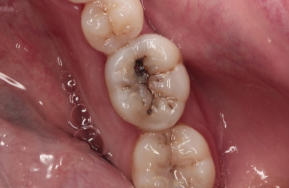 原创大牙窝沟有黑线怎么办时间长了会不会变成龋齿看看牙医怎么说