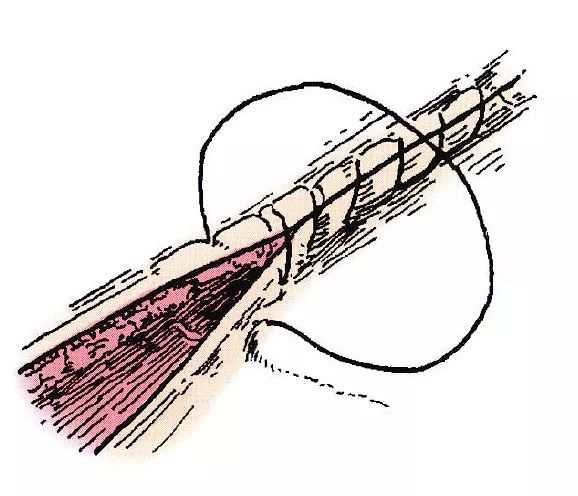 皮下连续缝合示意图图片