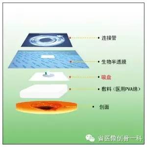 慢性骨髓炎的一种新疗法,引流管与负压源链接,是整个与vsd敷料相接触