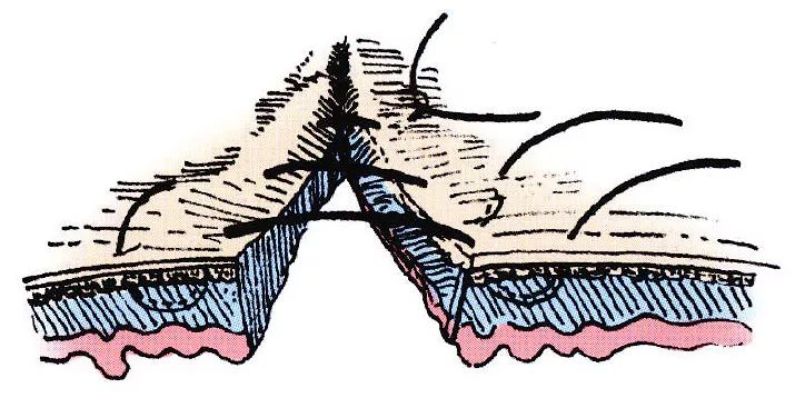 库兴氏缝合法(连续水平褥式内翻缝合法)这种缝合法是从伦勃特连续缝合