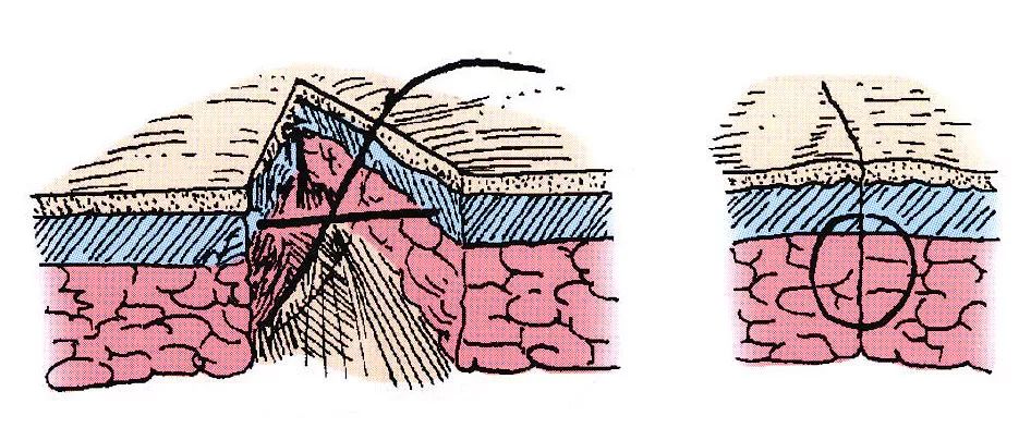 皮下缝合方法图解图片