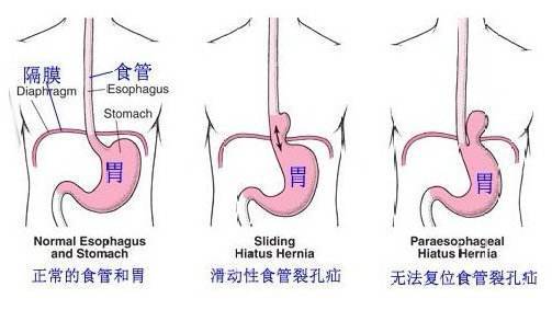 膈肌 食管裂孔图片