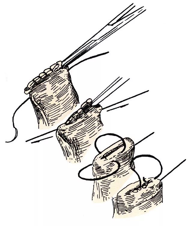 外科13种缝合方法图片
