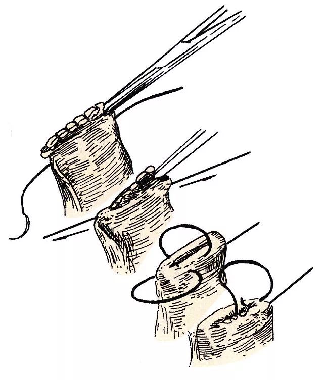 袋形缝合术 图解图片