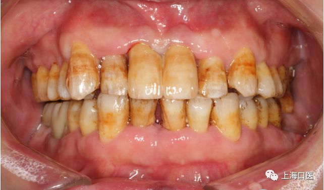 氟斑牙缺失后的种植修复病例