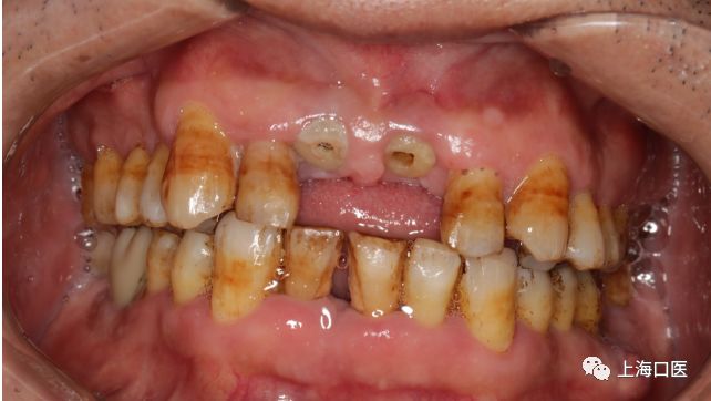 最严重的氟斑牙牙图片图片