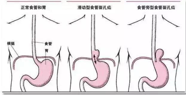 打嗝原理图片