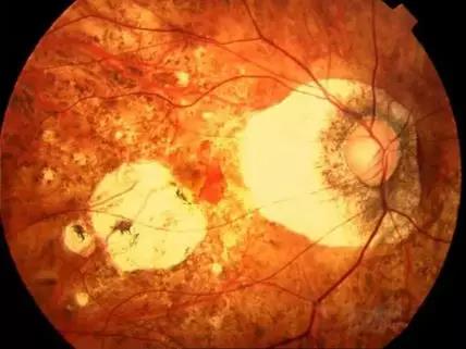 "来得晚 长得慢" 近视防控刻不容缓