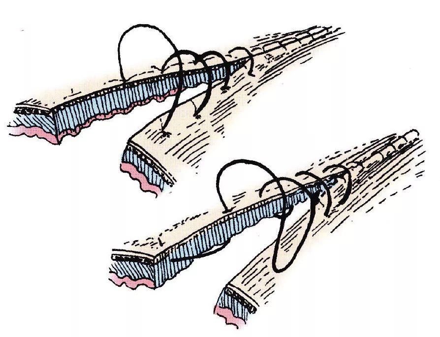 康乃尔缝合法这种缝合法与连续水平褥式内翻缝合相似,仅在缝合时缝针