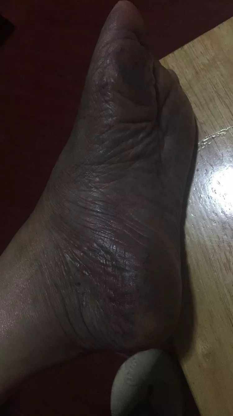 湿疹李道政虎符铜砭辨证配穴案例解析