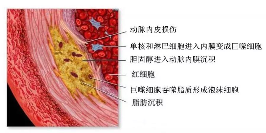 ldl-c通过受损的内皮进入动脉内膜,被巨噬细胞吞噬后成为泡沫细胞,在