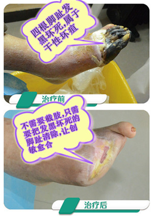 糖尿病足不截肢能治好吗?_坏疽