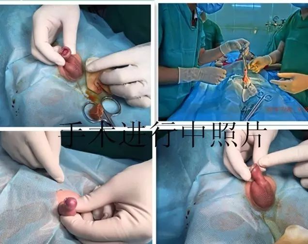 欧式包茎手术过程图片图片