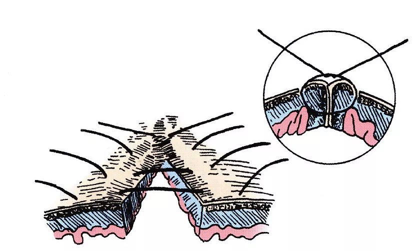水平内翻缝合法图解图片