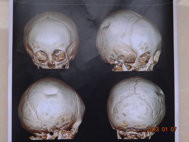 先天性颅骨缺损图片图片