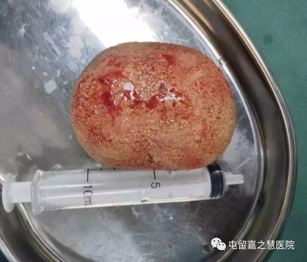 惊一男子膀胱长结石个头堪比鸭蛋