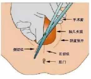 顺产撕裂到肛门图片图片