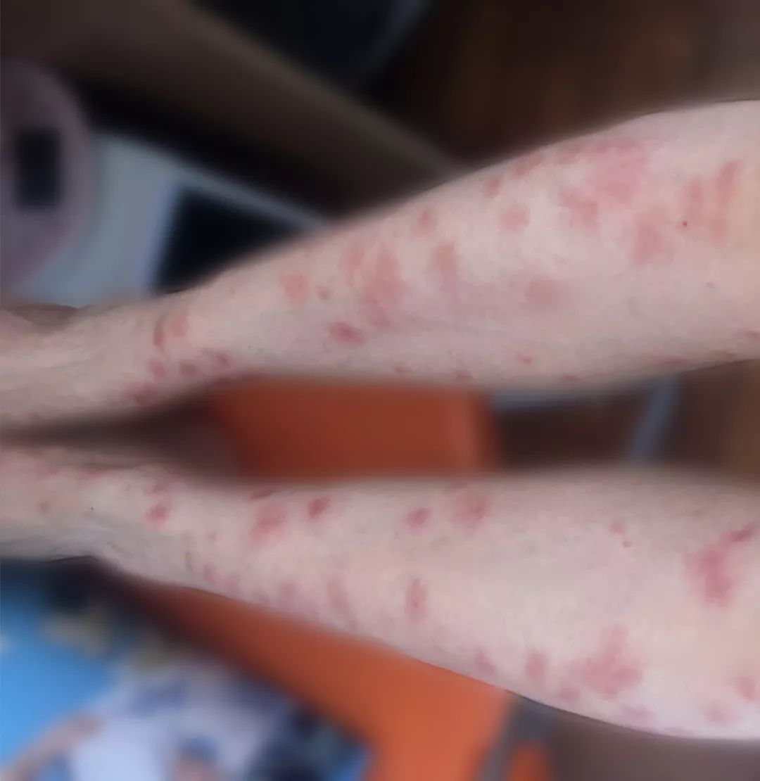 外出游玩当心深圳公园现神秘小黑虫被咬后奇痒无比