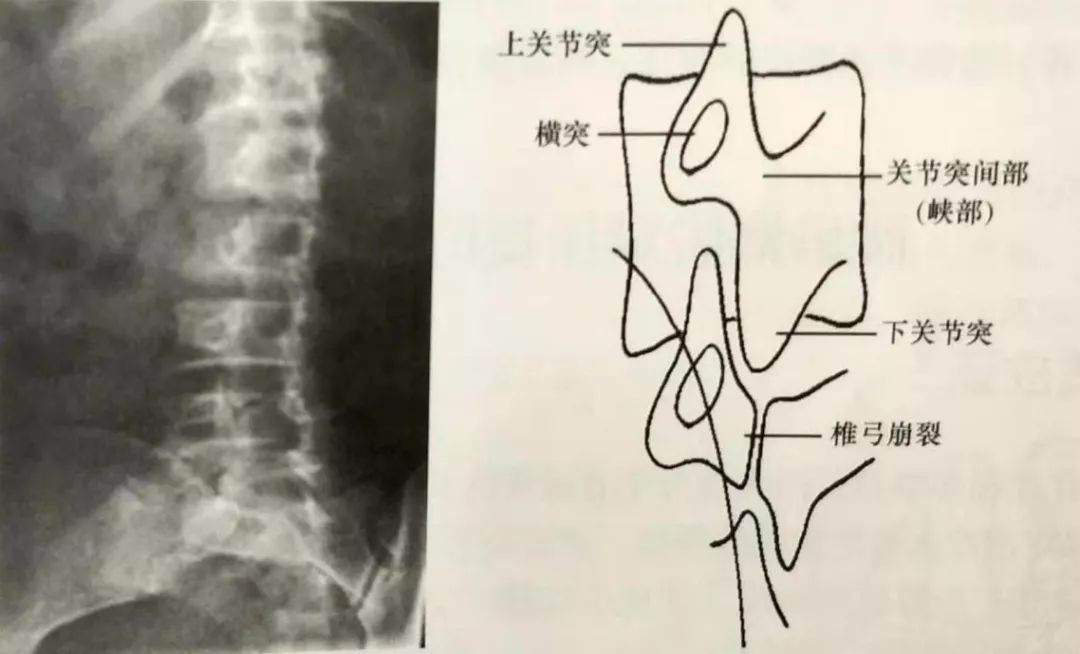 椎弓根位置图片