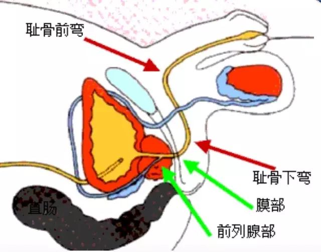 尿管插入技巧:稍用力使尿管滑入尿道,感到有輕輕的阻力,這是恥骨下彎