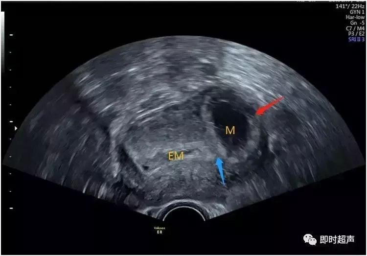 输卵管间质部妊娠