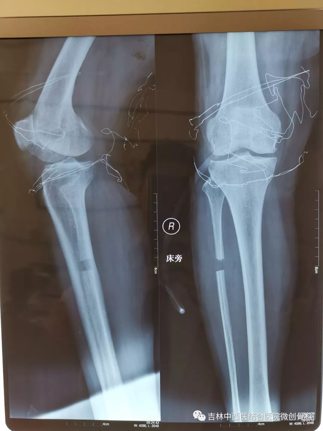 任杰开展关节镜 腓骨截骨技术治疗早中期骨性关节炎取得良好效果