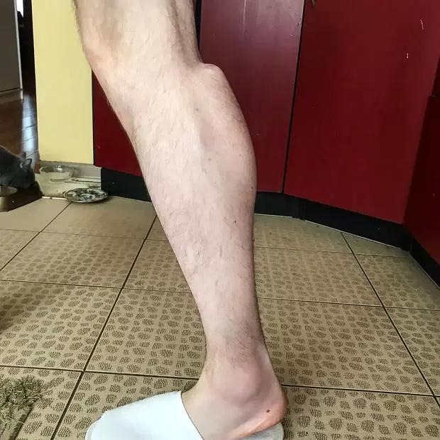 大力水手并非总是强大,俄罗斯健美运动员手臂近腰粗,面临截肢