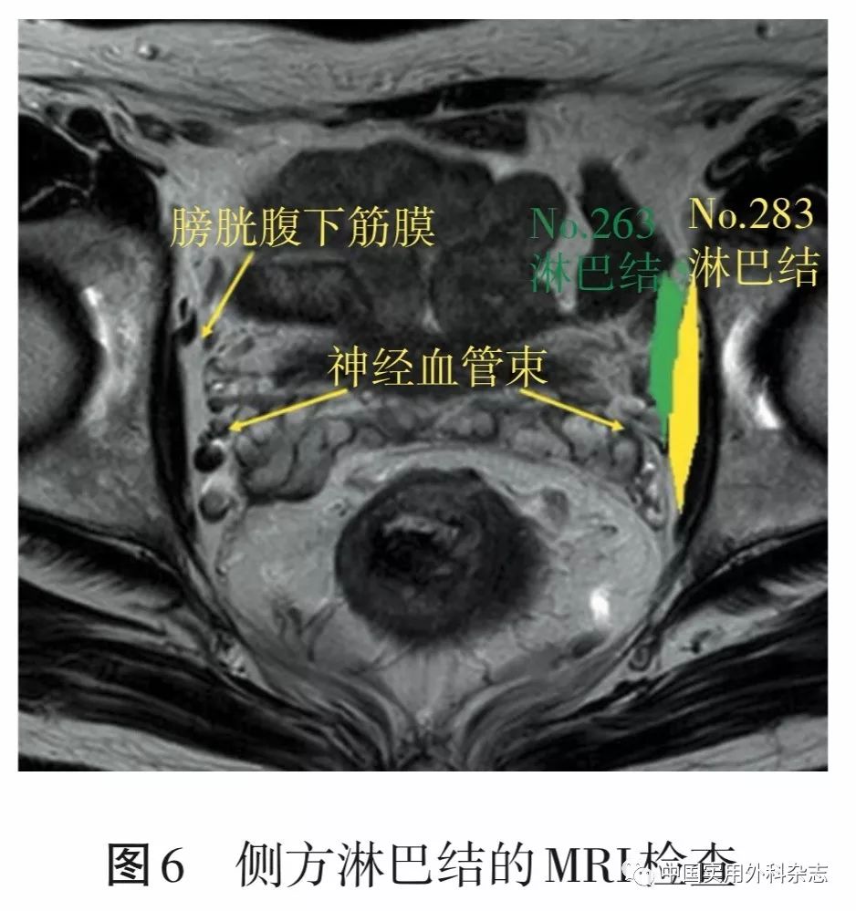 专题笔谈直肠周围间隙和盆底解剖