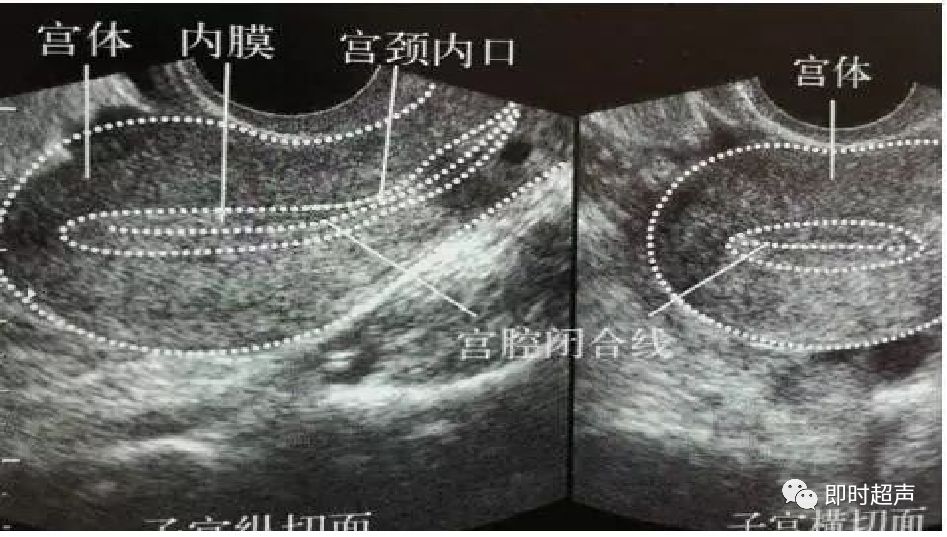 子宫横切面和纵切面图片