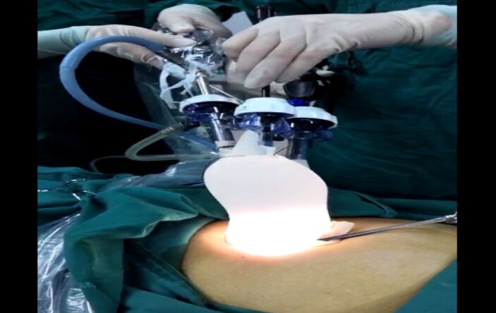 金堂县三医院单独成功开展全县首例单孔腹腔镜阑尾切除术_手术