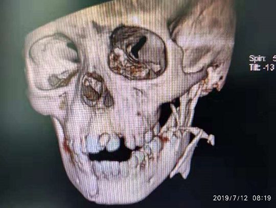 因这个动作,广西一8岁小男孩面部严重撕裂,暑假期间安全不容忽视