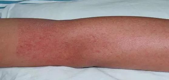 通过蚊虫叮咬传播!尚无特异性治疗药物!东阿人近期外出注意