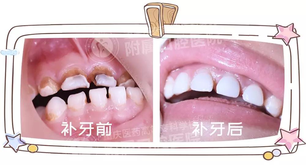 近日,重庆医高专附属口腔医院儿童口腔科成功完成了首例儿童睡眠治疗